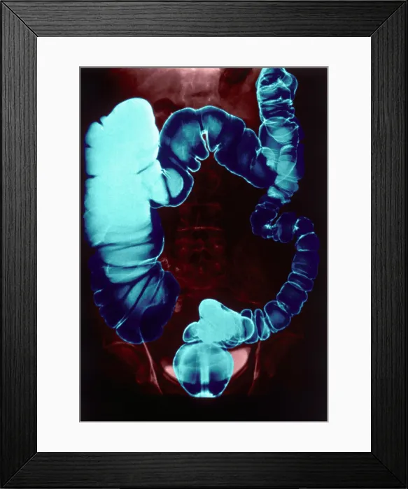 Framed Print : Colon Examination, Barium Enema
