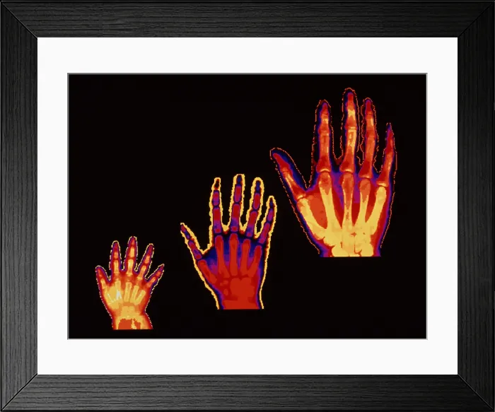 Framed Print : Bone growth at 2, 6, 19 years Framed Print : Bone growth at 2, 6, 19 years