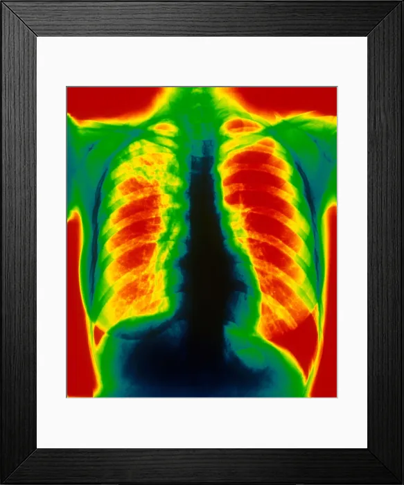 Framed Print : Tuberculosis, X-ray Framed Print : Tuberculosis, X-ray