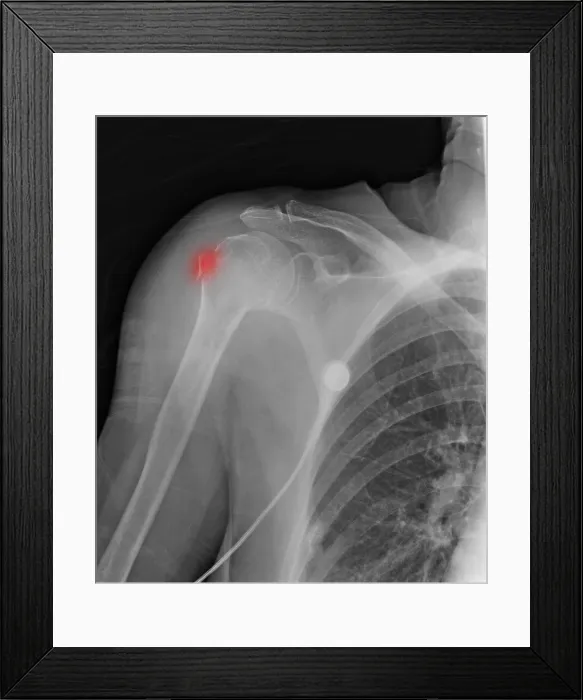 Framed Print : Upper Humerus Fracture, Osteoporosis Framed Print : Upper Humerus Fracture, Osteoporosis