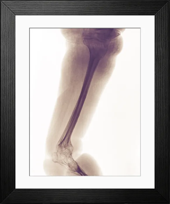 Framed Print : Severe Bone Degeneration in 63 Year Old Paraplegic Framed Print : Severe Bone Degeneration in 63 Year Old Paraplegic