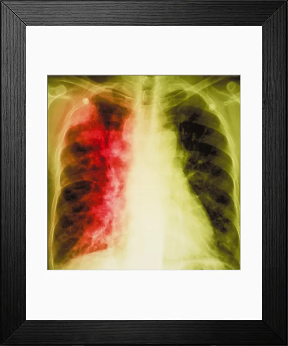 Framed Print : Lung cancer x-ray Framed Print : Lung cancer x-ray