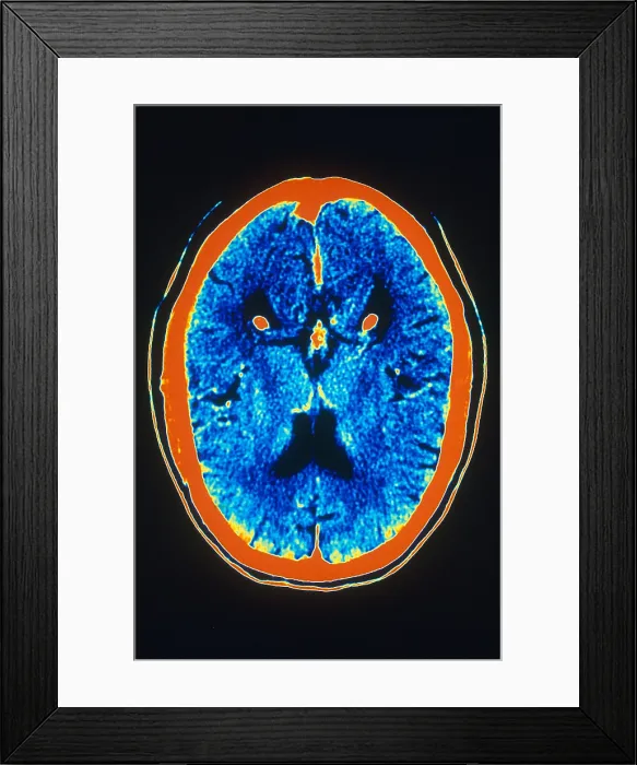 Framed Print : Brain, CT Scan Framed Print : Brain, CT Scan