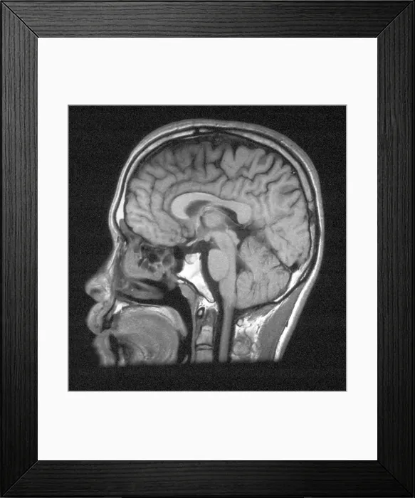Framed Print : Normal Brain Structures in Head, MRI Framed Print : Normal Brain Structures in Head, MRI
