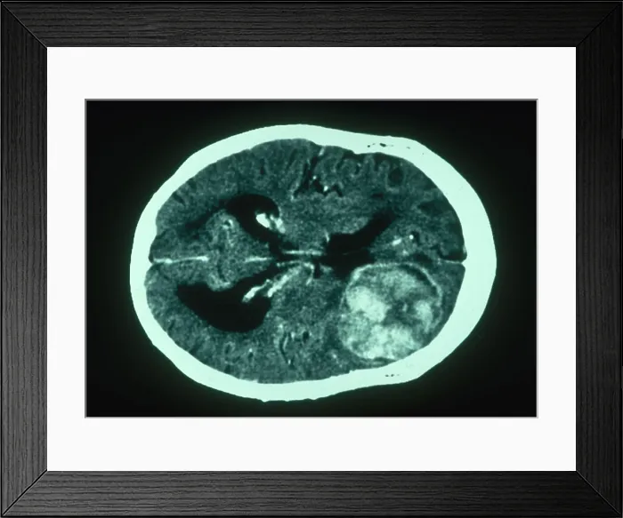 Framed Print : Brain Cancer, CT Scan Framed Print : Brain Cancer, CT Scan