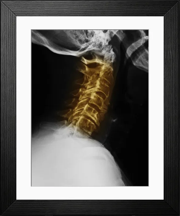 Framed Print : Degenerative Arthritis Framed Print : Degenerative Arthritis