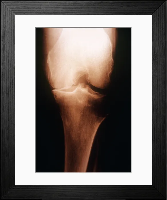 Framed Print : Osteoarthritis, X-ray
