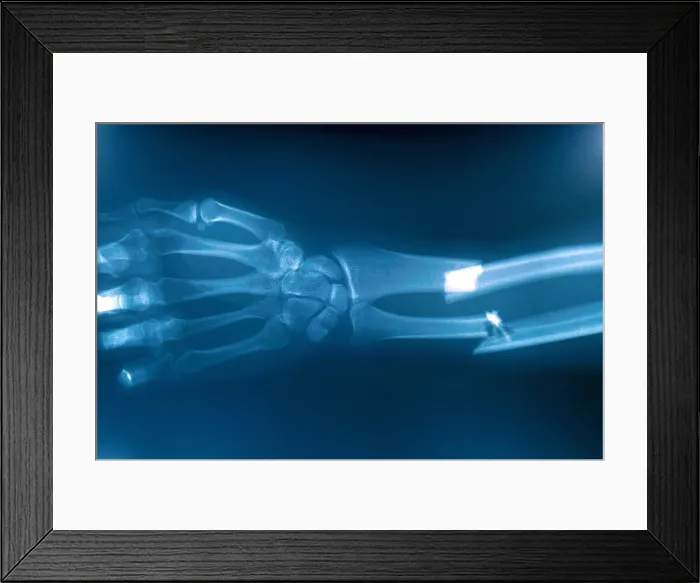 Framed Print : Broken Arm, X-ray