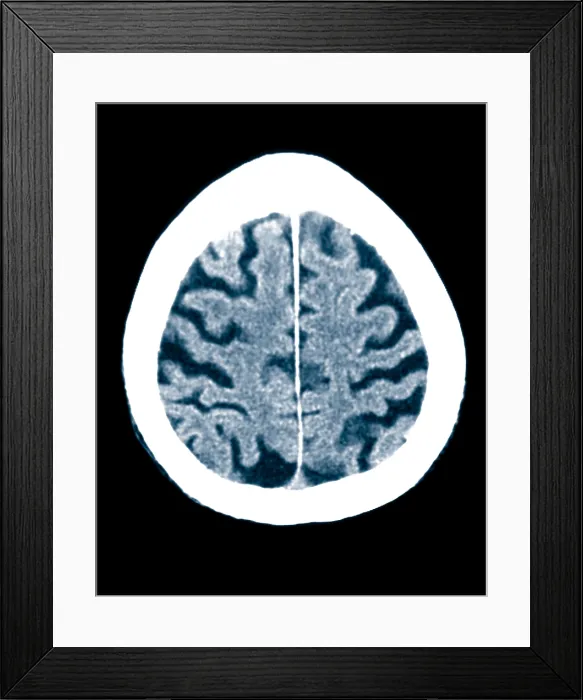 Framed Print : Brain of Alzheimer's Patient, CT Scan Framed Print : Brain of Alzheimer's Patient, CT Scan