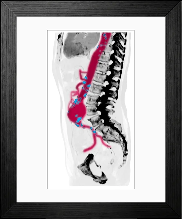 Framed Print : CT Scan of Abdominal Aortic Aneurysm