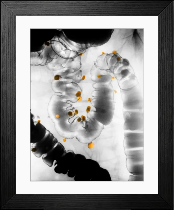 Framed Print : Diverticulosis Framed Print : Diverticulosis
