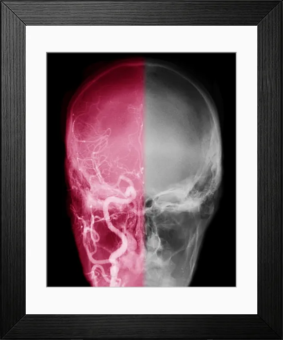 Framed Print : Cerebral Angiogram Framed Print : Cerebral Angiogram