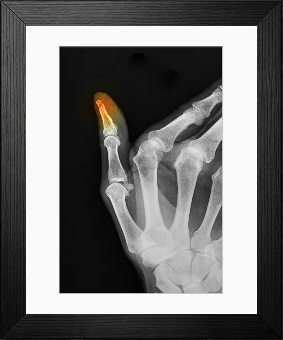 Framed Print : X-ray of Thumb Fracture
