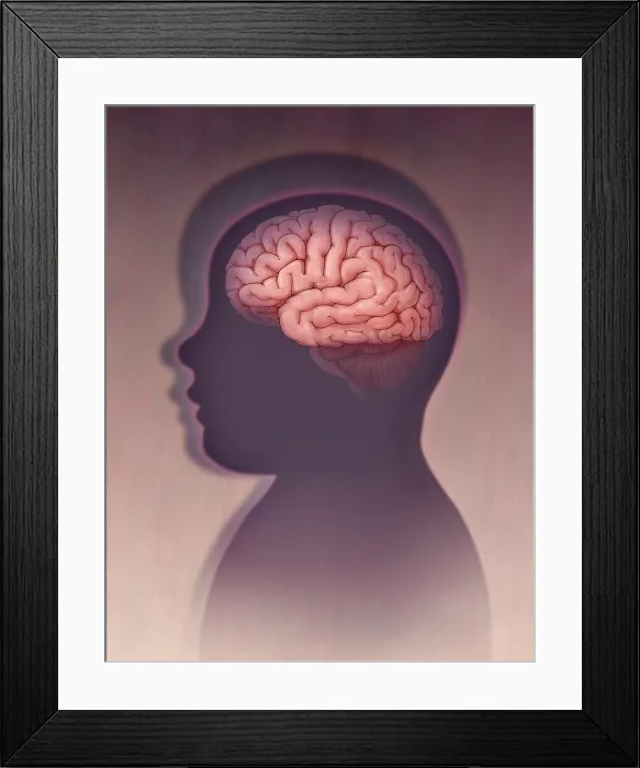 Framed Print : Microcephaly, illustration Framed Print : Microcephaly, illustration