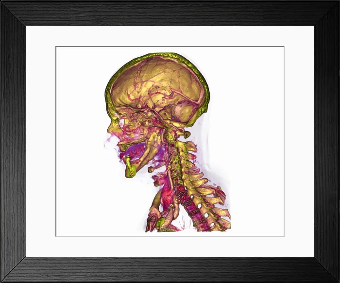 Framed Print : Male Skull & Arterial System Framed Print : Male Skull & Arterial System