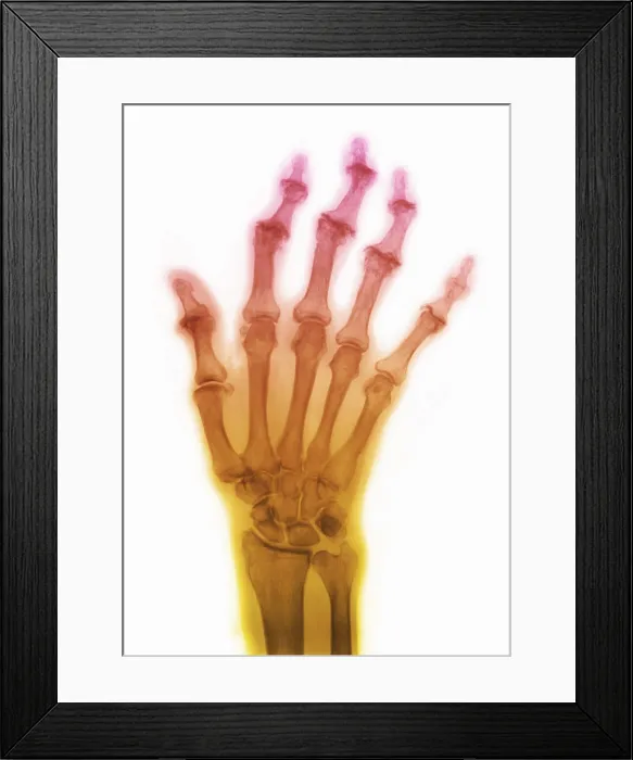 Framed Print : Degenerative Arthritis Framed Print : Degenerative Arthritis