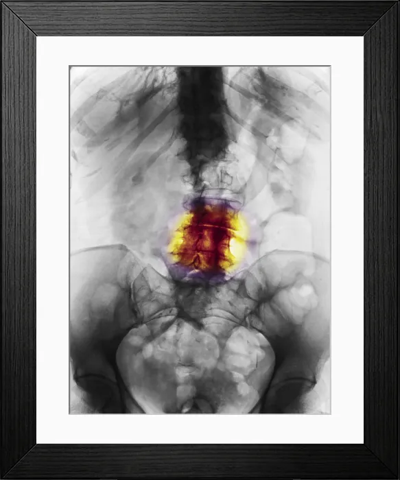 Framed Print : Degenerative Arthritis Framed Print : Degenerative Arthritis