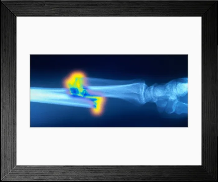 Framed Print : Broken Arm, X-ray Framed Print : Broken Arm, X-ray