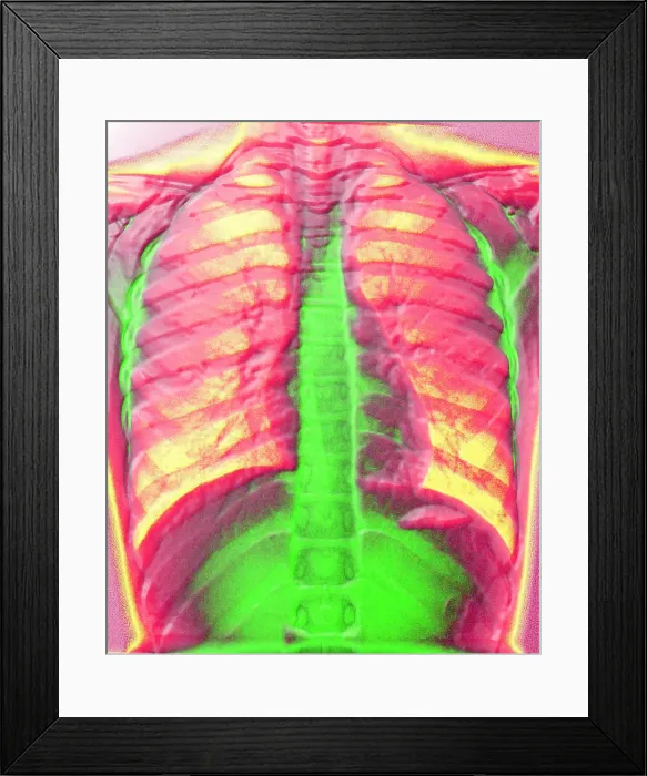 Framed Print : A normal chest X-ray