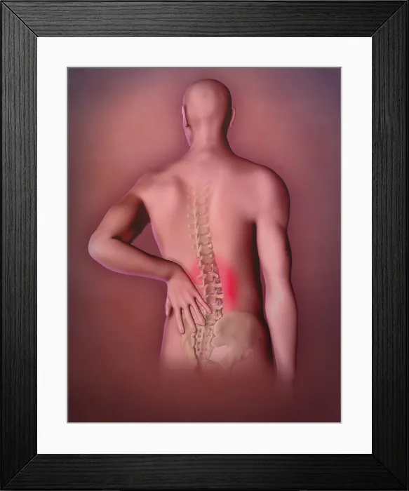 Framed Print : Back Pain, Illustration Framed Print : Back Pain, Illustration