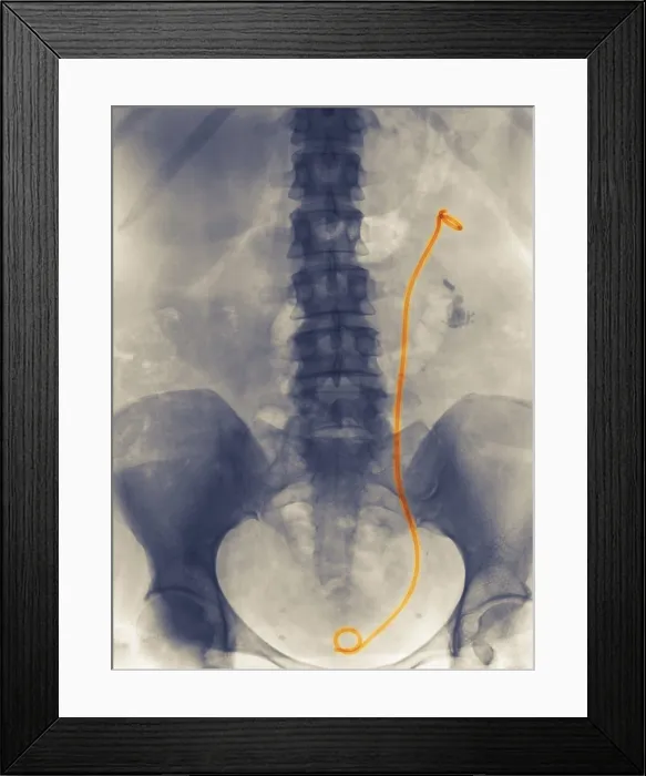 Framed Print : Stent from Kidney to Bladder Framed Print : Stent from Kidney to Bladder