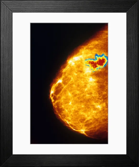 Framed Print : Mammogram indicating breast cancer. Color enhanced Framed Print : Mammogram indicating breast cancer. Color enhanced