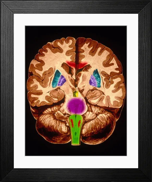 Framed Print : Brain, Coronal Section Framed Print : Brain, Coronal Section