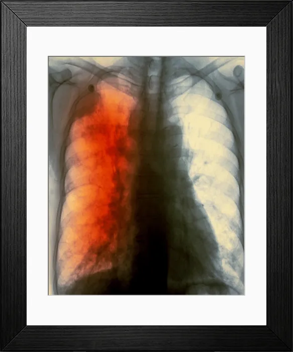 Framed Print : Lung cancer x-ray Framed Print : Lung cancer x-ray
