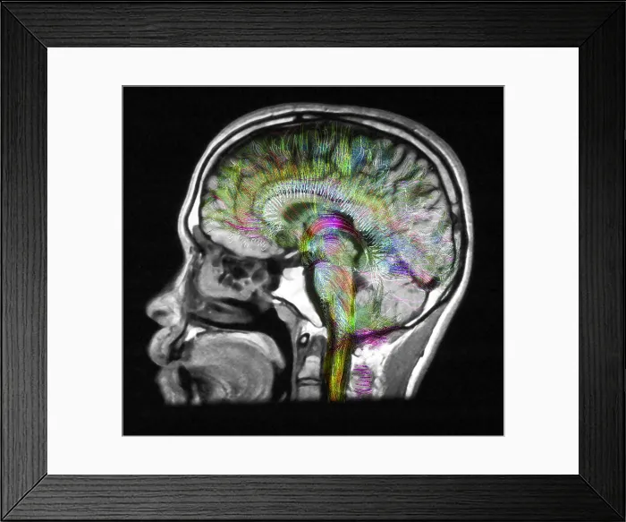 Framed Print : Normal Brain, Fiber Tractography and MRI Framed Print : Normal Brain, Fiber Tractography and MRI