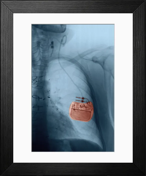 Framed Print : Vagus Nerve Stimulator, Epilepsy, X-Ray Framed Print : Vagus Nerve Stimulator, Epilepsy, X-Ray