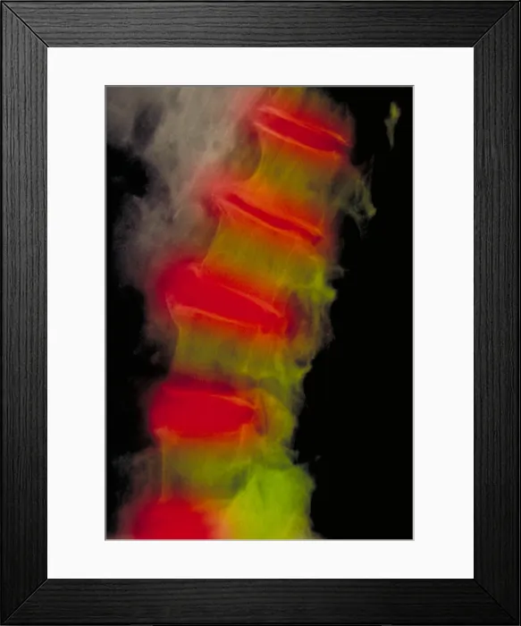 Framed Print : Lumbar spine x-ray, severe osteoarthritis Framed Print : Lumbar spine x-ray, severe osteoarthritis