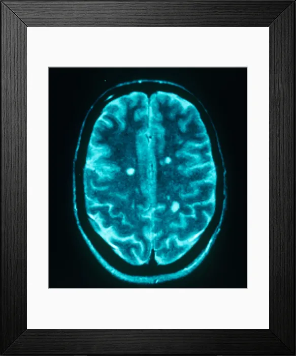 Framed Print : MRI Multiple Sclerosis Framed Print : MRI Multiple Sclerosis