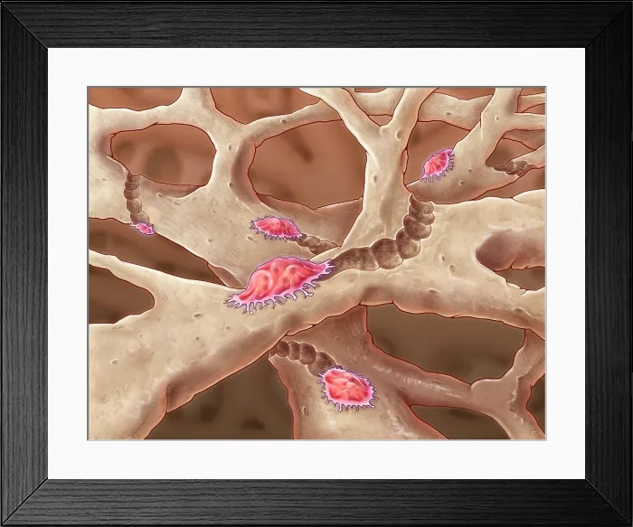 Framed Print : Osteoclasts, illustration Framed Print : Osteoclasts, illustration