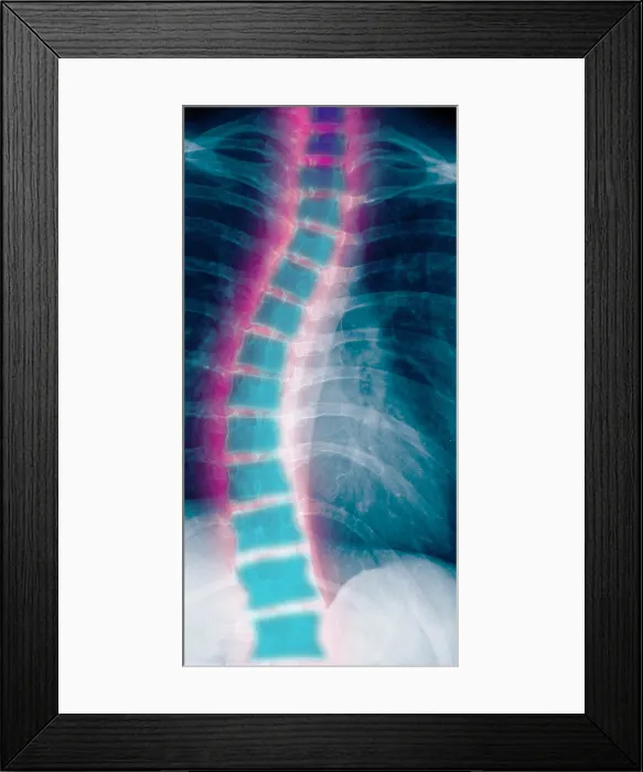 Framed Print : X-ray of scoliosis Framed Print : X-ray of scoliosis