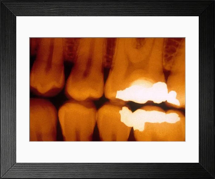 Framed Print : Fillings, X-ray Framed Print : Fillings, X-ray