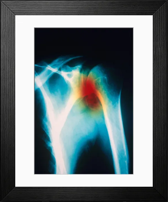 Framed Print : Osteoarthritis, X-ray Framed Print : Osteoarthritis, X-ray