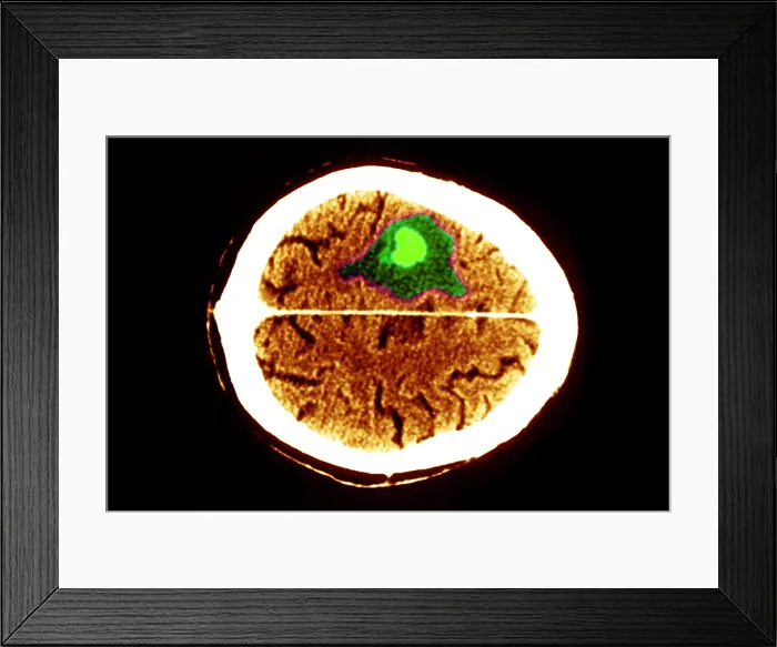 Framed Print : Brain edema Framed Print : Brain edema