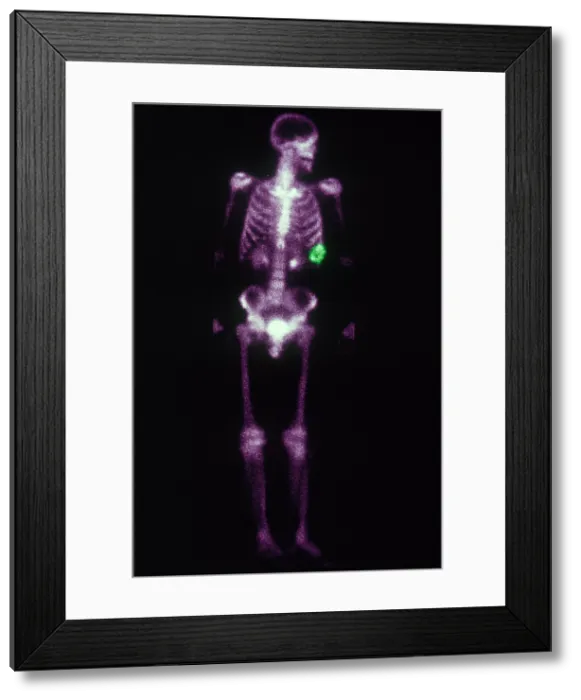 Framed Print : Chondrosarcoma Framed Print : Chondrosarcoma