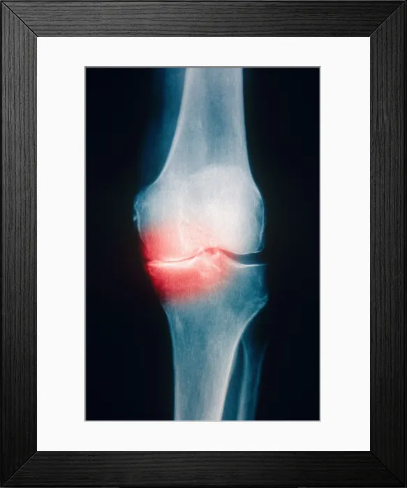 Framed Print : Osteoarthritis, X-ray