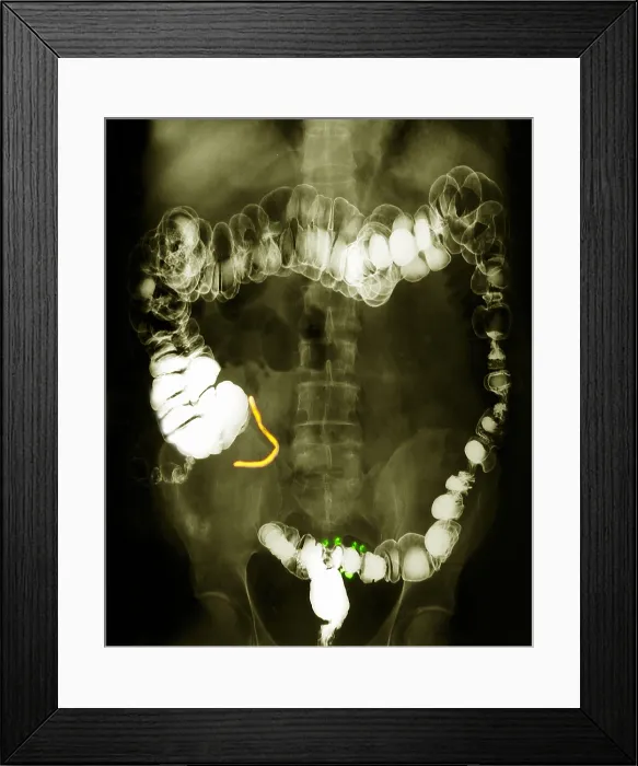 Framed Print : Colon x-ray with barium contrast Framed Print : Colon x-ray with barium contrast