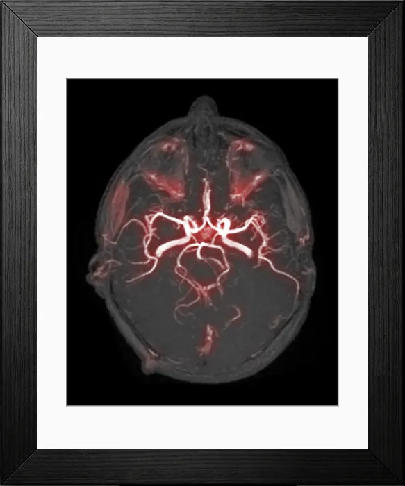 Framed Print : Circle of Willis, Angiogram Framed Print : Circle of Willis, Angiogram