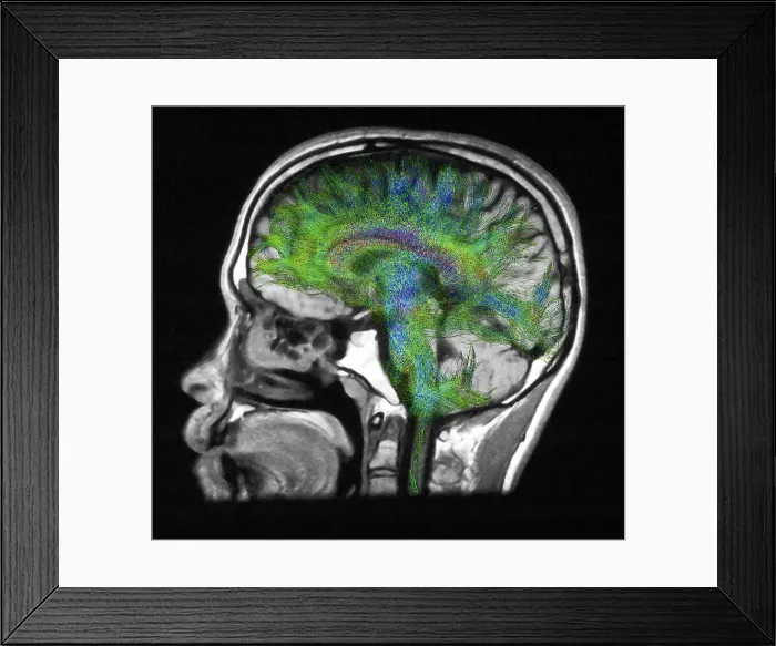 Framed Print : Normal Brain, Fiber Tractography and MRI Framed Print : Normal Brain, Fiber Tractography and MRI