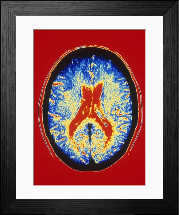 Framed Print : Brain, CT Scan Framed Print : Brain, CT Scan
