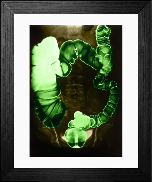 Framed Print : Colon Examination, Barium Enema Framed Print : Colon Examination, Barium Enema