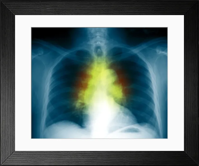 Framed Print : Sarcoidosis Framed Print : Sarcoidosis