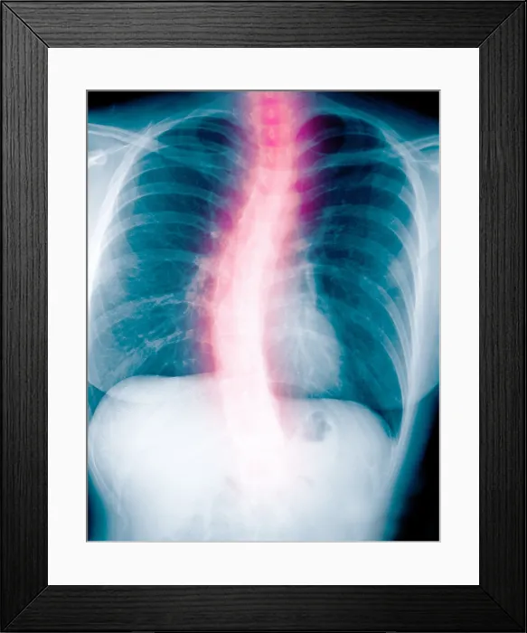 Framed Print : X-ray of scholiosis Framed Print : X-ray of scholiosis