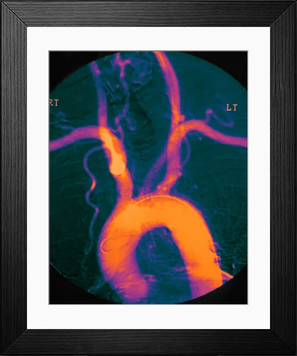 Framed Print : Aortic Arch Framed Print : Aortic Arch