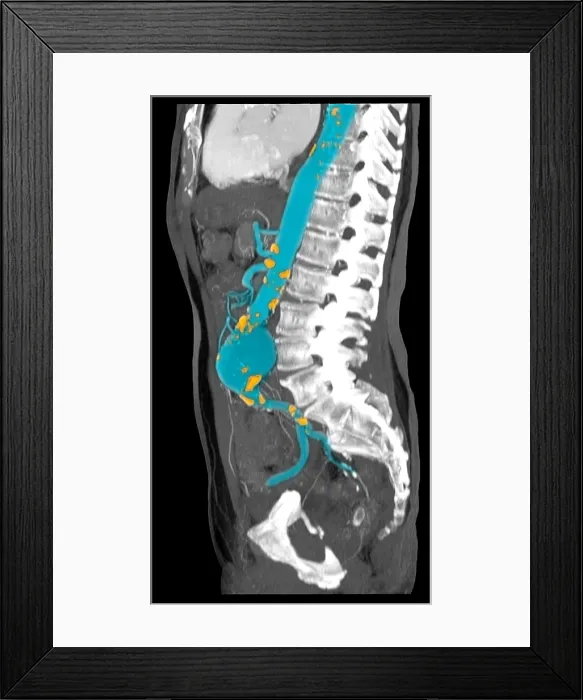 Framed Print : CT Scan of Abdominal Aortic Aneurysm