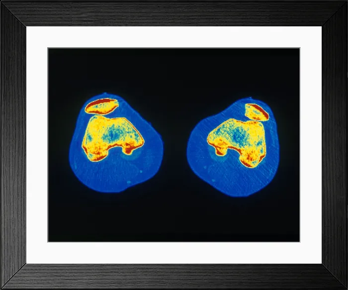 Framed Print : Knees, CT Scan
