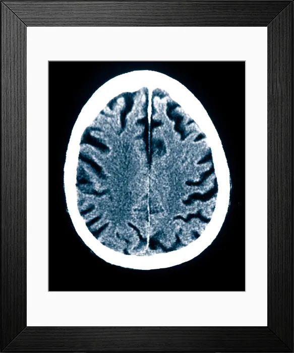 Framed Print : Brain of Alzheimer's Patient, CT Scan Framed Print : Brain of Alzheimer's Patient, CT Scan